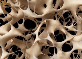 Osteoporose. Foto: Divulgação
