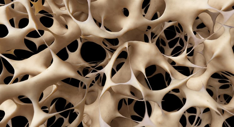 Osteoporose. Foto: Divulgação