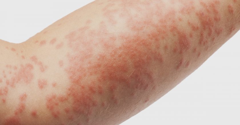 Dermatite atópica. Foto: Reprodução de Internet