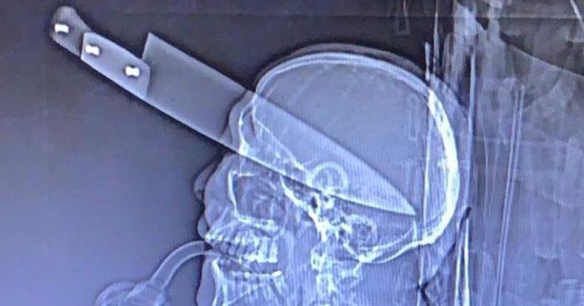 Raio-x mostra a faca cravada no olho de vítima. Foto: TV Morena/Reprodução
