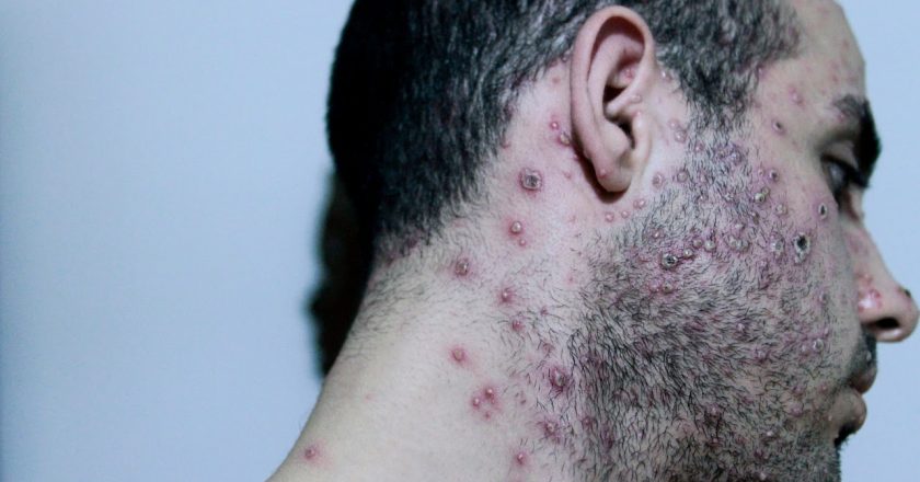 Foto: Homem com sintomas da Varíola dos Macacos. Foto: Divulgação/ADRA Brasil