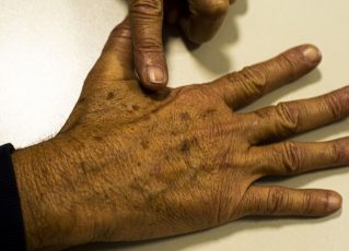 Tecnologia para tratar câncer de pele é aprovado para uso no SUS. Foto: Marcello Casal Jr./Agência Brasil